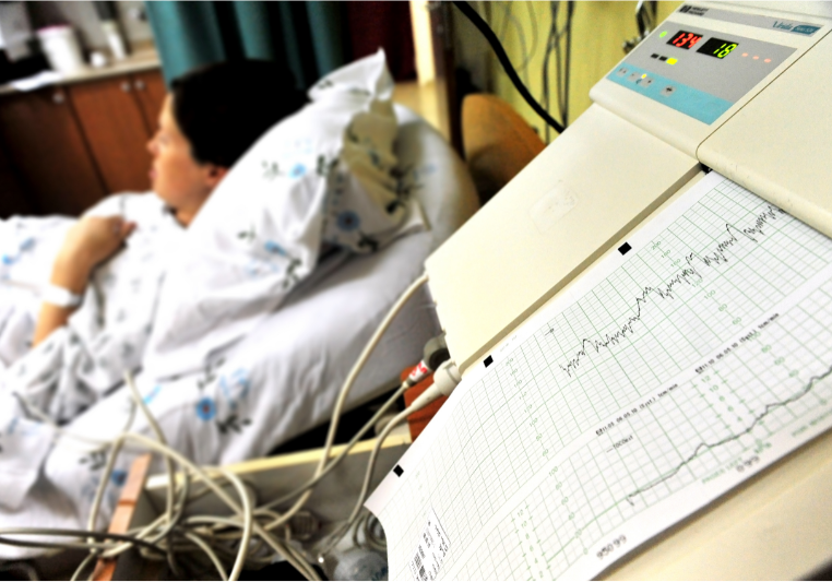 Neonatal Stroke and Maternal GBS Infection